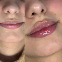 آفر  تزریق ژل و بوتاکس