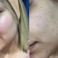 کرم بیوممتیک + جوانساز و جایگزین بوتاکس