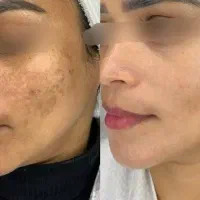 روش تضمینی رفع لک و کک و مک