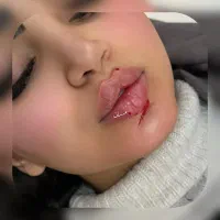 بوتاکس ۷۵۰ ژل لب روسی ۹۸۰(پزشک متخصص)