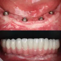 دندانپزشکی ایمپلنت۱۵ تومن در تبریز بااقساط ۲۴ ماهه