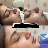 آف جراحی بینی ۲۰تومن دراهوازولیپوساکشن وابدو