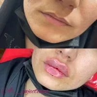 آموزش و تزریق ژل و بوتاکس