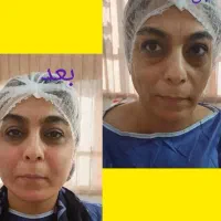 تزریق ژل و بوتاکس .تزریق چربی