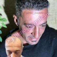 معجزه کاشت مو شیراز در شهرتبریز