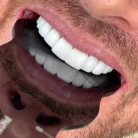 خدمات دندان با بیمه های تکمیلی