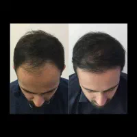 پیشانیت بلند شده...