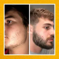 رویش فوق‌العاده ریش