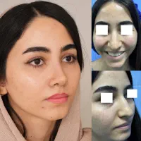 عمل جراحی بینی باجدیدترین روش روزدنیا وتخفیف۵۰درصد