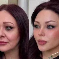 مدل زیباسازی وجوانسازی شفاف ولیف صورت به مدت محدود