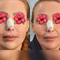 جشنواره تخفیف  بوتاکس و ژل لب  فقط به مدت۳روز