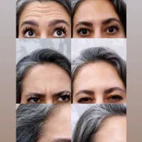 بوتاکس صورت و زیربغل
