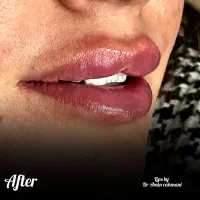 تزریق ژل ،بوتاکس،مزو توسط پزشک با شرایط اقساط