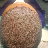 کاشت مو به روش FIT،ریش و ابرو با بهترین قیمت