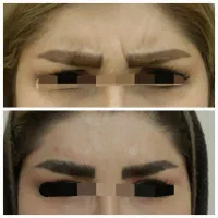 تزریق بوتاکس