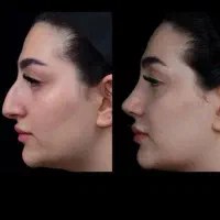 عمل بینی با قیمت مناسب و نتیجه ی عالی