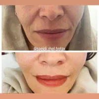 تزریق فیلر(ژل)وبوتاکس