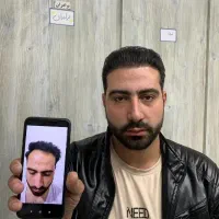 کاشت مو،ابرو در کلینیک تخصصی در تبریز