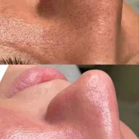 جشنواره تخفیفی خدمات   پاکسازی صورت و فیشال