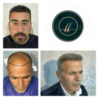 کاشت مو و ابرو ریش + شرایط اقساطی