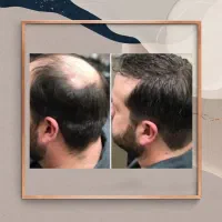 تار موهاتو ضخیم کن