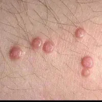 لیزر زگیل تناسلی و خالبرداری در ایلام