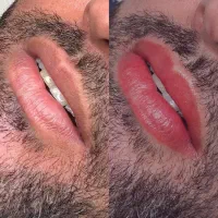 رفع تیرگی لب اقایان رفع سیاهی لب