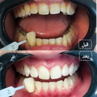 بلیچینگ دندان حرفه ای - آفر ویژه 3.5.0.0 دوفک