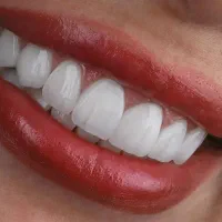 دندان پزشکی ترمیم عصبکشی ‌ارتودنسی لمینت ایمپلنت