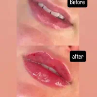 خدمات تخصصی زیبایی و جوانسازی (بوتاکس،فیلر،مزوژل)
