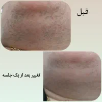 لیزر موهای زائد دستگاه تیتانیوم (ویژه بانوان)