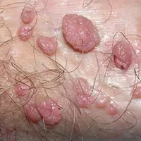 خال، انواع زگیل، جراحی سرپایی توسط پزشک