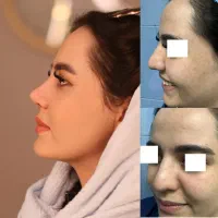 جراحی بینی در تهران با آف ۵۰درصد،جشنواره دی ماه