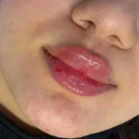 فیلر با تکنیک های روز کره ای