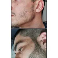 موهای پرپشت دوباره