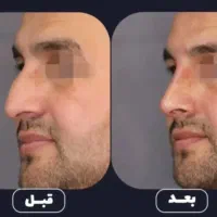 جادوی فرم‌دهی بینی بدون جراحی