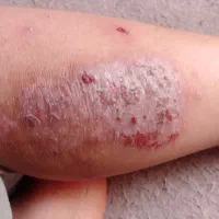 علاج زخم دیابتی