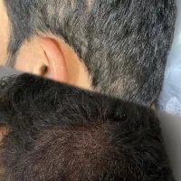 آرایش دائم سر به روش FUT FUE