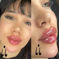 جشنواره ژل لب روسی فیلرزاویه بوتاکس مزو لیزرفیشیال