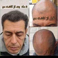 تخفیفات زمستانه،کاشت مو وابرو