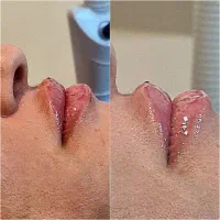 تزریق ژل لب.ژل گونه.بوتاکس.ژل باسن.آنزیم ژل