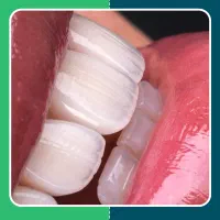 لمینت سرامیکی EMAX کیفیت شرایط