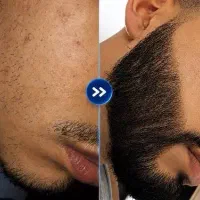 یکماهه پرپشتش کن