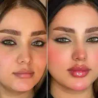 آموزش ژل و بوتاکس و مزو