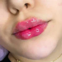 خدمات ژل و بوتاکس