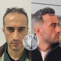 کاشت مو ۲۲ کاشت ابرو ۱۵