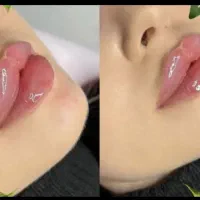 مدل رایگان ژل و بوتاکس