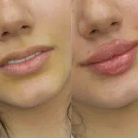 تزریق ژل و بوتاکس