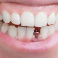 تخصصی ایمپلنت لمینت کامپوزیت