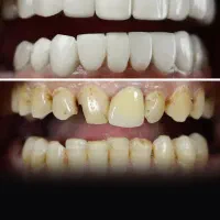 پروتز ثابت ـ متحرک ـ دائمی/کامپوزیت دندون